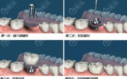 种半口种植牙的具体步骤有哪些？从术前到术后需经历哪些环节？