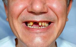 老人牙掉光了，种牙真的有必要吗？