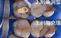 补牙常见方法有哪些？哪种更适合自己？