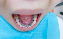 正畸个别牙舌倾