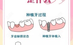 种牙种植深度多少才合适？
