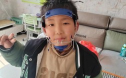 牙齿摇动矫正固定，如何实现稳固矫正？