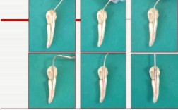 根管充填不同方法（如冷牙胶侧压、热牙胶垂直加压等）的临床效果与并发症发生率有何差异？如何根据患牙情况选择最优方案？