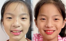 小孩反合（地包天）正畸前后图片对比能看出哪些牙齿变化？正畸过程中家长需要注意哪些关键问题？