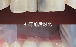 正畸期间可否补牙