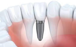 中秋种植牙靠谱吗？现在做来得及吗？