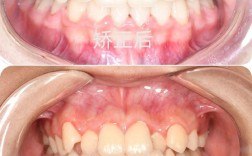 矫正牙齿为何要拔四颗？这步操作有必要吗？