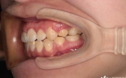 拔牙正畸矫正失败？原因究竟出在哪？