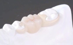 种牙与粘结桥，哪种牙齿修复方式更优？