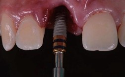 苏州即刻种牙效果如何？当天就能用吗？