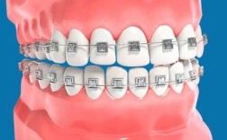 牙齿正畸带环缺点有哪些？矫正中需警惕哪些问题？