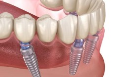 allon4种植牙图片