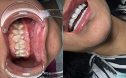 带全植牙会口臭吗