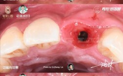 植牙骨失败案例