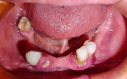 浙江省口腔种牙