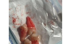 矫正牙齿拔了虎牙后悔