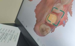 隐形正畸口扫几次