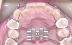 进口前牵装置正畸效果怎样？适合骨性畸形矫正吗？