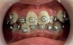 正畸治疗中MBT托槽粘结位置标准的临床应用关键要点有哪些？