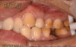 种牙后临时修复有何作用？护理要点与注意事项有哪些？