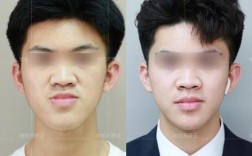 正颌手术前正畸很难看