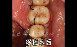 正畸智齿代替第一磨牙可行吗？效果如何？