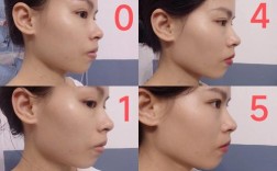 嘴突骨性正畸 日记