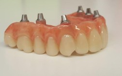 即刻种植牙视频揭秘，种植过程是怎样的？效果真实吗？优势在哪？