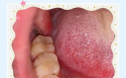 拔牙后牙齿怎么修复？常用方法有哪些？