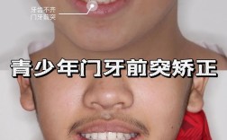青年正畸案例，矫正周期长，效果与疼痛如何平衡？