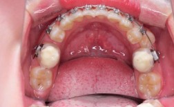 正畸牵引尖牙博客