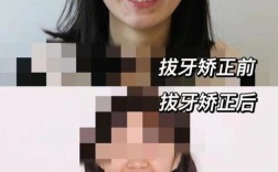 矫正牙齿后的感受