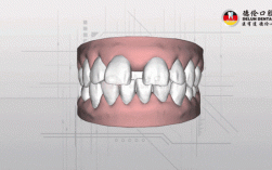 矫正牙齿过程动态图
