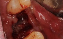 种植牙后口腔为何会发炎？原因分析与应对措施有哪些？