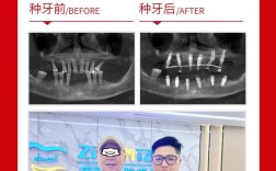 想种牙却不知哪家医院靠谱？从技术实力、医生经验到价格透明度，这些关键因素该怎么考量？