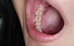 智齿未萌出就正畸，会影响矫正效果和智齿后续生长吗？