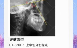 正畸头侧位影像中Z点该如何精准定位？