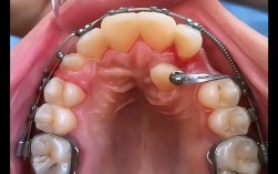 正畸牵引倒置埋伏牙