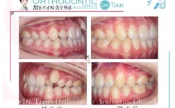 正畸过程出现牙根突出