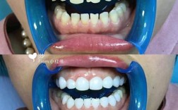 正畸后做牙贴面