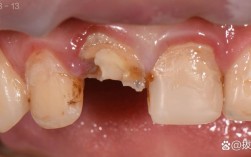 种牙后牙冠高度不够是什么原因？该如何处理？