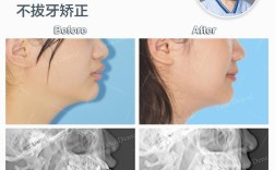 凸面型可以通过正畸矫正改善吗？有哪些具体方法？