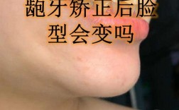 矫正牙齿能改变凸嘴吗？效果取决于牙齿和骨骼情况
