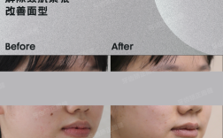 矫正牙齿真的会让嘴唇变厚吗？矫正后嘴唇厚度会有变化吗？