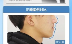 浙江省内反颌正畸专家去哪找？治疗效果好不好？靠谱吗？