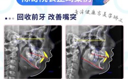 反颌正畸拔牙，矫正的必要选择还是无奈之举？