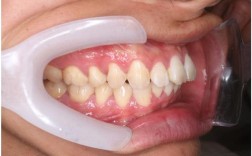 倾斜后牙正畸直立