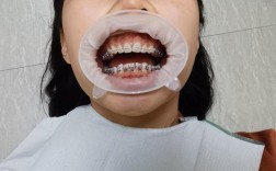 23岁做牙齿矫正