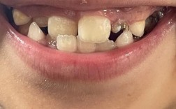 歪牙矫正效果如何？能让牙齿彻底变整齐吗？