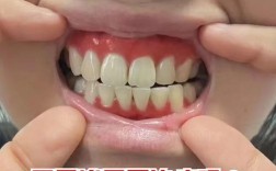 我有牙周炎能种牙吗